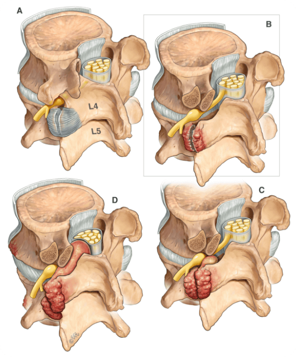 Facet Syndrome Disease | EndoSpine | Leaders in Endoscopic Spine Surgery