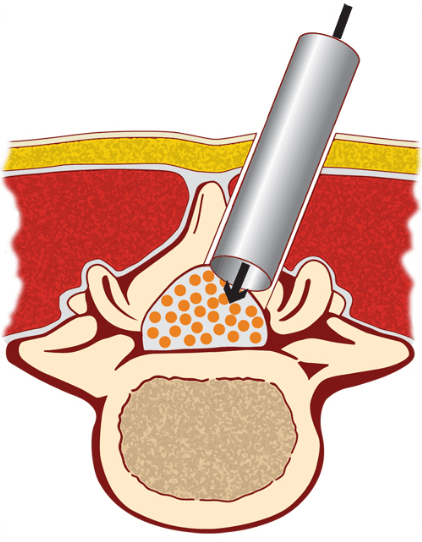 MIS Laminectomy | Spinal Stenosis | EndoSpine | Leaders in Endoscopic Spine Surgery