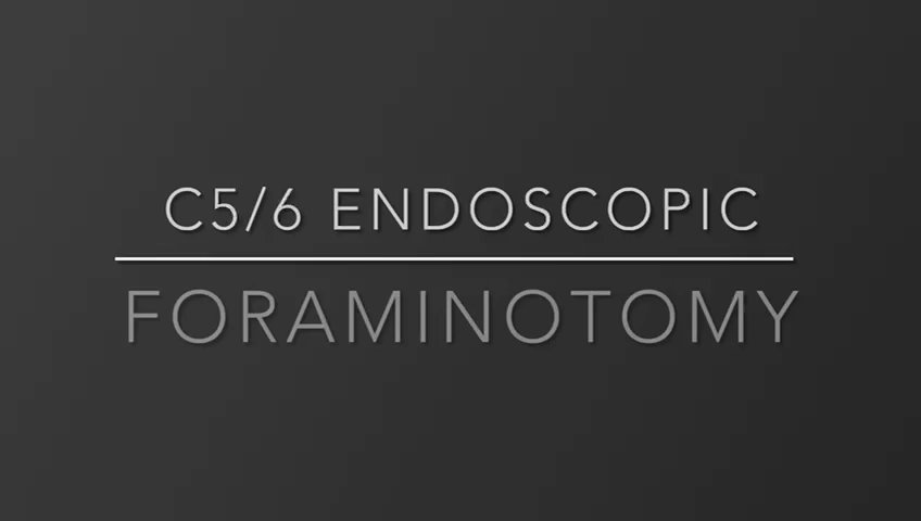 C5/6 Encoscopic Foraminotomy