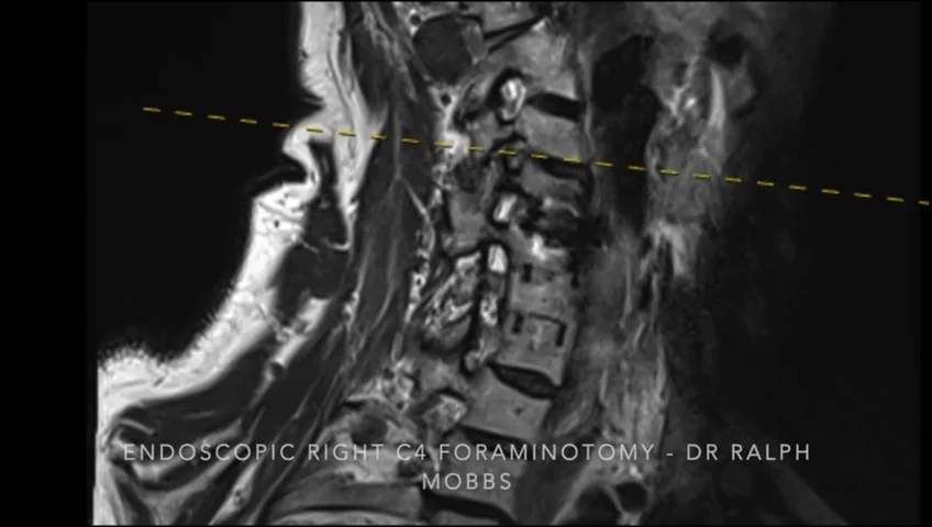 Endoscopic Right C4 Foraminotomy